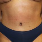 Tummy Tuck Before & After Patient #19878