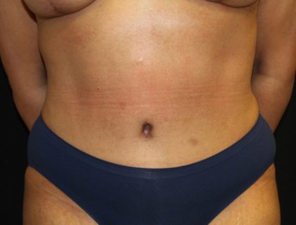 Tummy Tuck Before & After Patient #19878