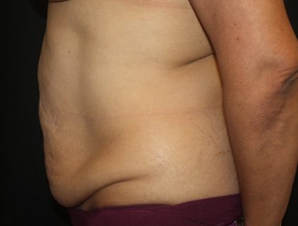 Tummy Tuck Before & After Patient #19878