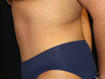 Tummy Tuck Before & After Patient #19878