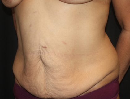 Tummy Tuck Before & After Patient #19878