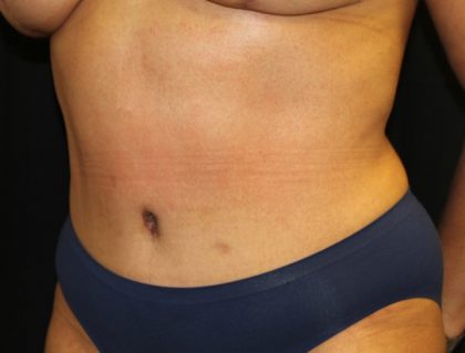 Tummy Tuck Before & After Patient #19878