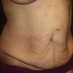 Tummy Tuck Before & After Patient #19878