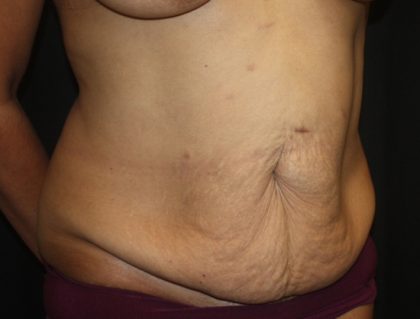 Tummy Tuck Before & After Patient #19878