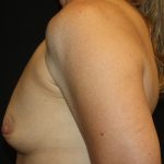 Breast Augmentation - Saline Implants Before & After Patient #20562