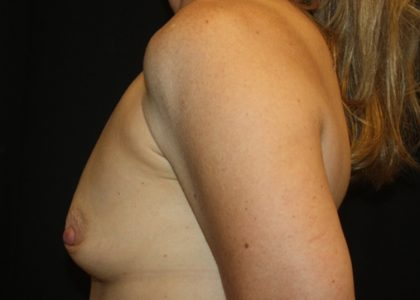 Breast Augmentation - Saline Implants Before & After Patient #20562