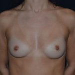 Breast Augmentation - Round Silicone Implants Before & After Patient #20389