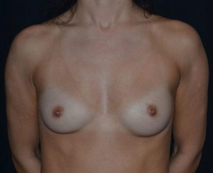 Breast Augmentation - Round Silicone Implants Before & After Patient #20389