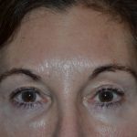 Blepharoplasty Before & After Patient #20124