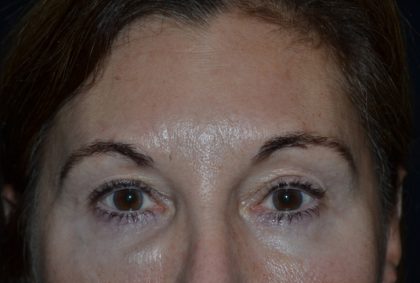 Blepharoplasty Before & After Patient #20124