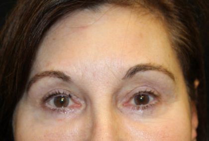 Blepharoplasty Before & After Patient #20124