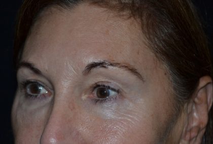 Blepharoplasty Before & After Patient #20124