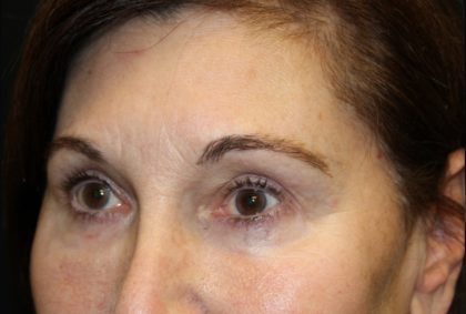 Blepharoplasty Before & After Patient #20124