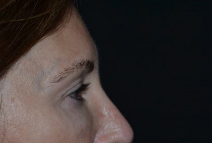 Blepharoplasty Before & After Patient #20124