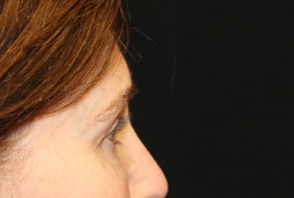 Blepharoplasty Before & After Patient #20124