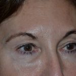 Blepharoplasty Before & After Patient #20124