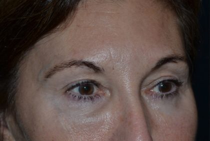 Blepharoplasty Before & After Patient #20124