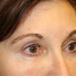 Blepharoplasty Before & After Patient #20124