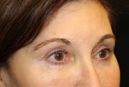 Blepharoplasty Before & After Patient #20124