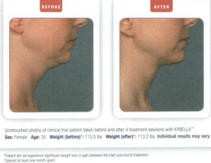 How Can Kybella Help With That Annoying Bra Bulge?, Voorhees, Sewell,  South Jersey, NJ