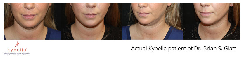 kybella near me nj
