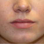 Injectable Fillers Before & After Patient #21335