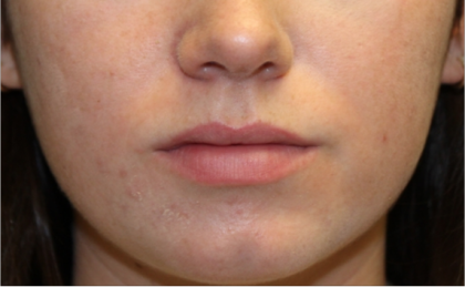 Injectable Fillers Before & After Patient #21335