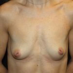 Nipple Revision Before & After Patient #20860