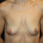 Breast Lift with Implant Before & After Patient #20749