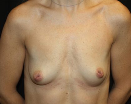 Breast Lift with Implant Before & After Patient #20749
