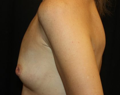 Breast Lift with Implant Before & After Patient #20749