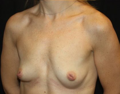 Breast Lift with Implant Before & After Patient #20749