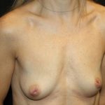 Nipple Revision Before & After Patient #20860