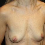 Breast Lift with Implant Before & After Patient #20749