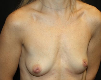 Breast Lift with Implant Before & After Patient #20749