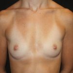 Breast Augmentation - Round Silicone Implants Before & After Patient #20388