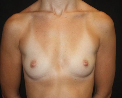 Breast Augmentation - Round Silicone Implants Before & After Patient #20388