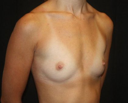 Breast Augmentation - Round Silicone Implants Before & After Patient #20388