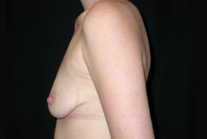 Breast Augmentation - Round Silicone Implants Before & After Patient #25742