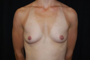 Breast Augmentation - Round Silicone Implants Before & After Patient #25764