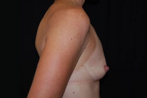 Breast Augmentation - Round Silicone Implants Before & After Patient #25764