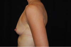 Breast Augmentation - Round Silicone Implants Before & After Patient #25764