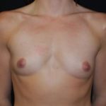 Breast Augmentation - Round Silicone Implants Before & After Patient #25773