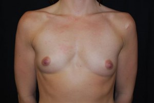 Breast Augmentation - Round Silicone Implants Before & After Patient #25773