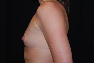 Breast Augmentation - Round Silicone Implants Before & After Patient #25773