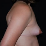 Breast Augmentation - Round Silicone Implants Before & After Patient #26057