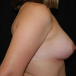 Breast Augmentation - Round Silicone Implants Before & After Patient #26057