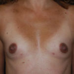 Breast Augmentation - Round Silicone Implants Before & After Patient #26112