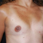 Breast Augmentation - Round Silicone Implants Before & After Patient #26112