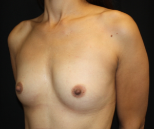 Breast Augmentation - Round Silicone Implants Before & After Patient #26123
